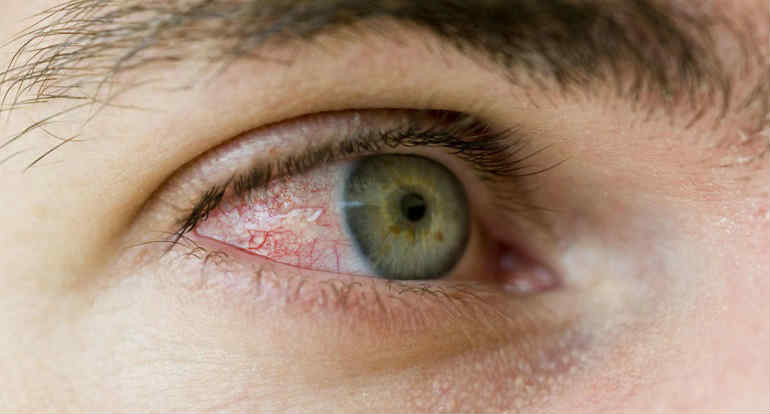 Блефарит глаза симптомы