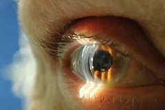 Буллезная кератопатия роговицы глаза