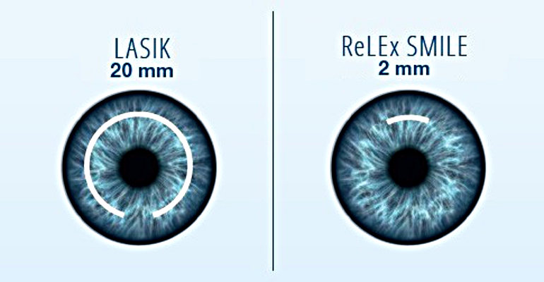 Цены и отзывы после операции лазерной коррекции зрения