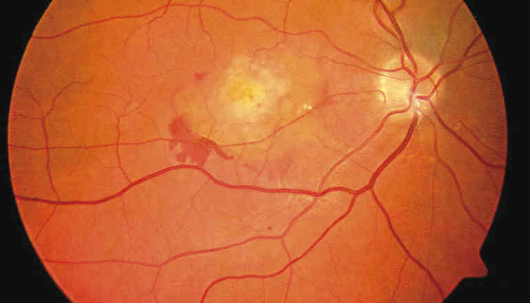 Диабетическая ретинопатия симптомы