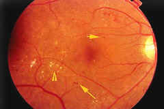 Диабетическая ретинопатия причины