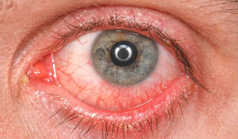 Глазное давление повышено симптомы