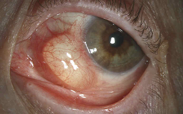 Дермоидная киста глаза: диагностика, лечение
