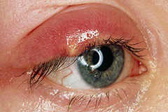 Лечение халязиона глаза в Наро-Фоминске