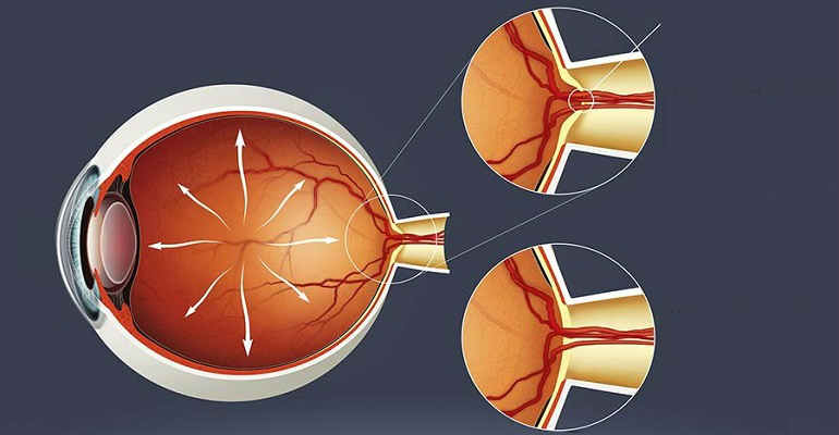 Как проявляется офтальмогипертензия