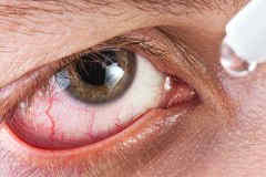 Повреждения роговицы глаза