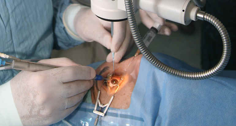 Что такое рефракционная микрохирургия глаза