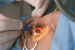 Рефракционная хирургия глаза - что это