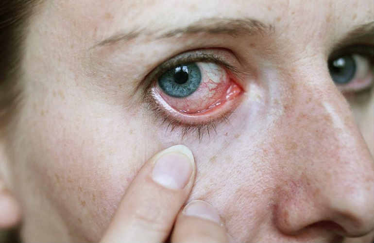 Царапина на роговице глаза симптомы